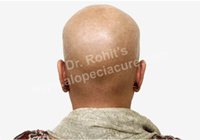 chemotherapy hair loss