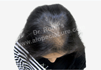 female hair loss