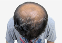 male hair loss