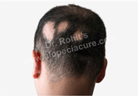 scarring alopecia