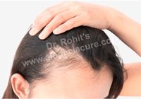 traction alopecia