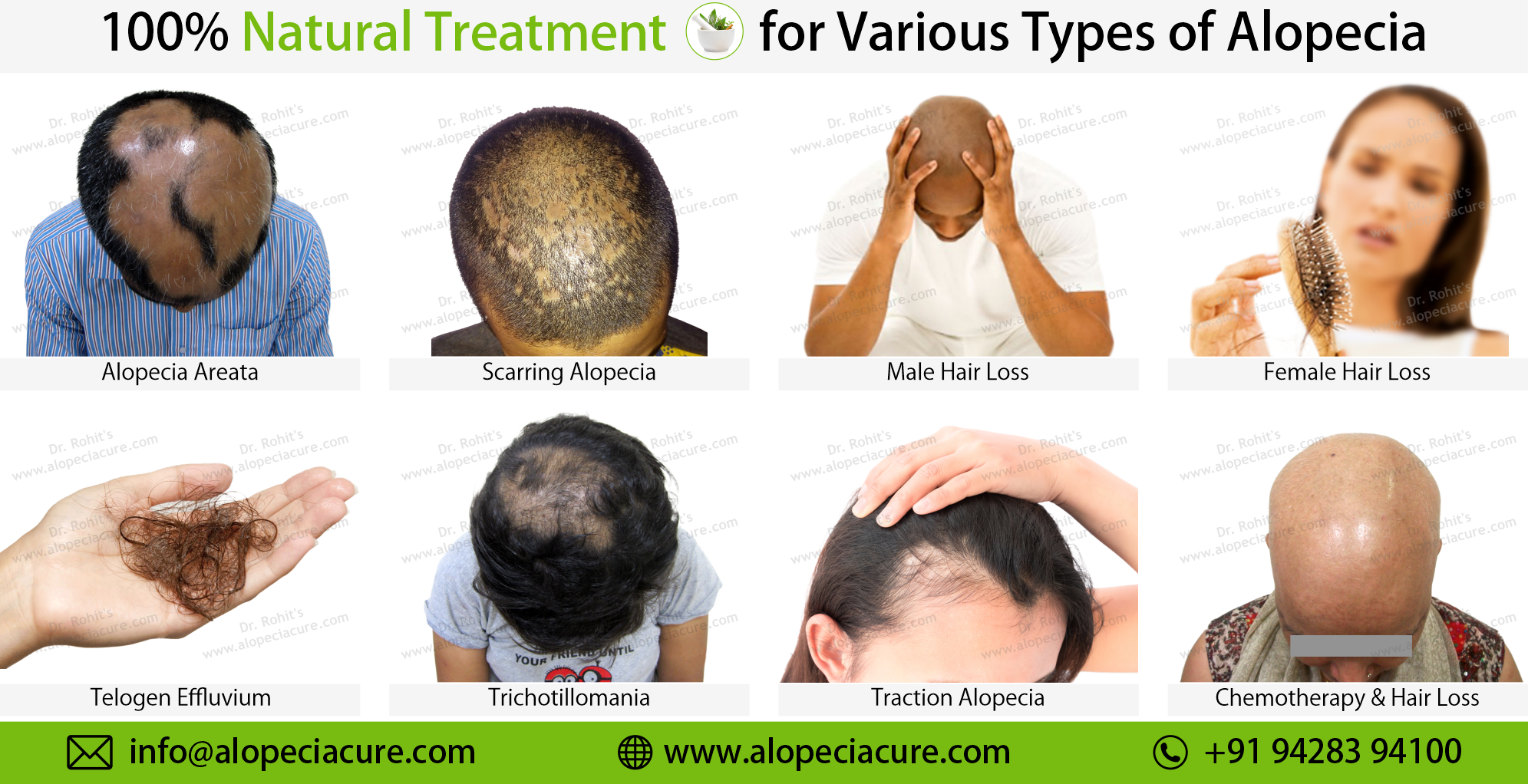 types of alopecia