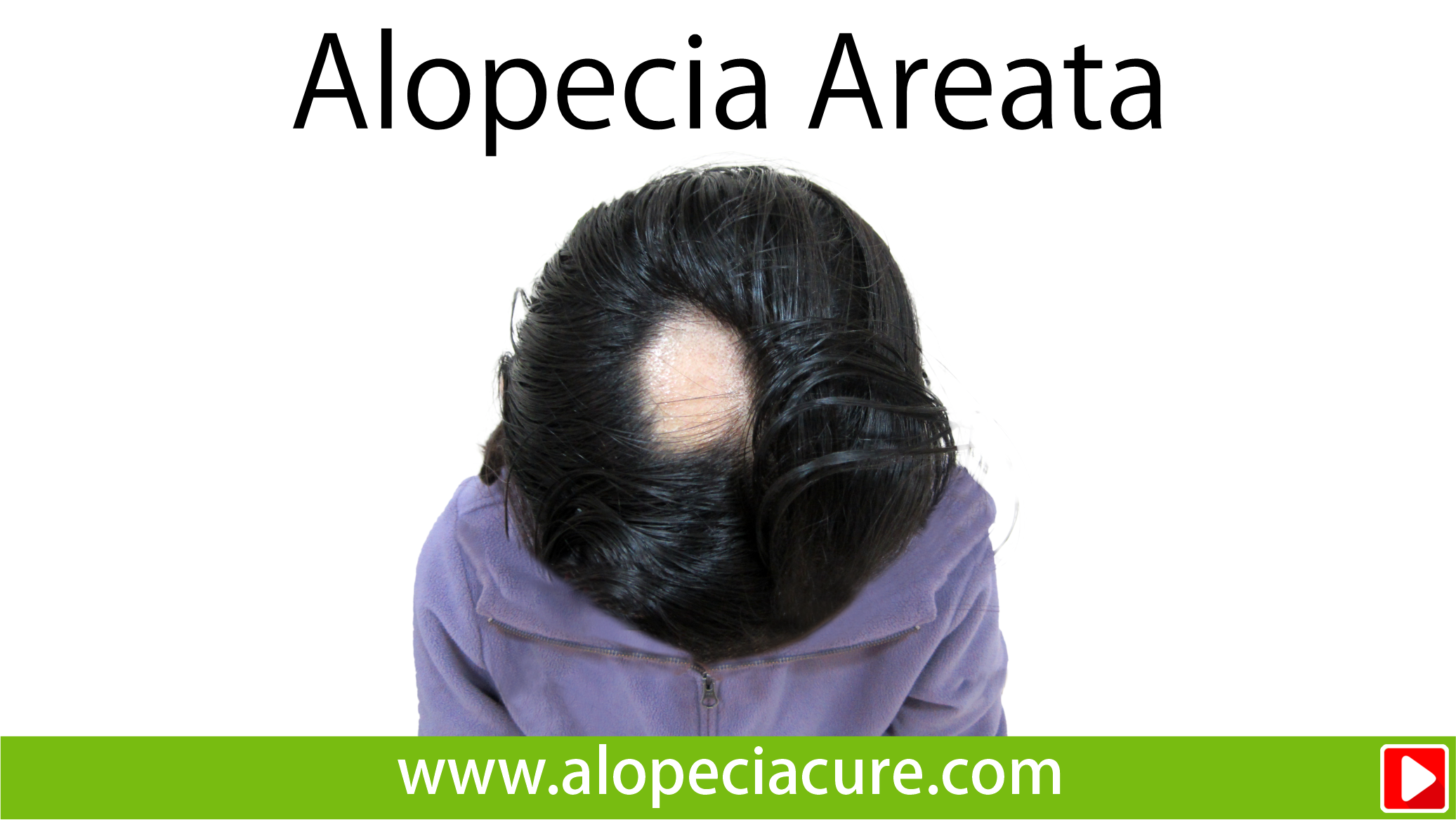 alopecia areata