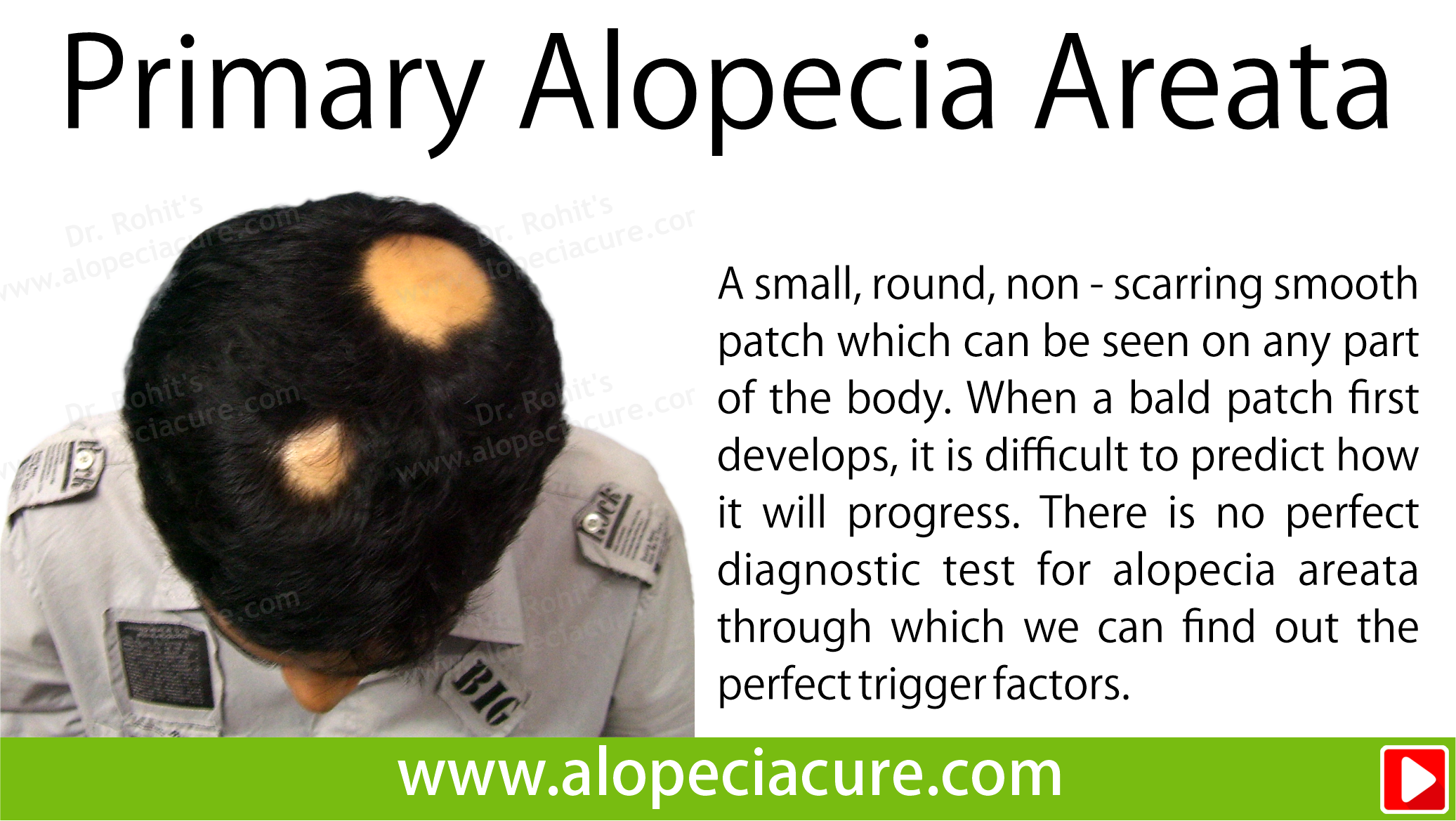 primary alopecia areata