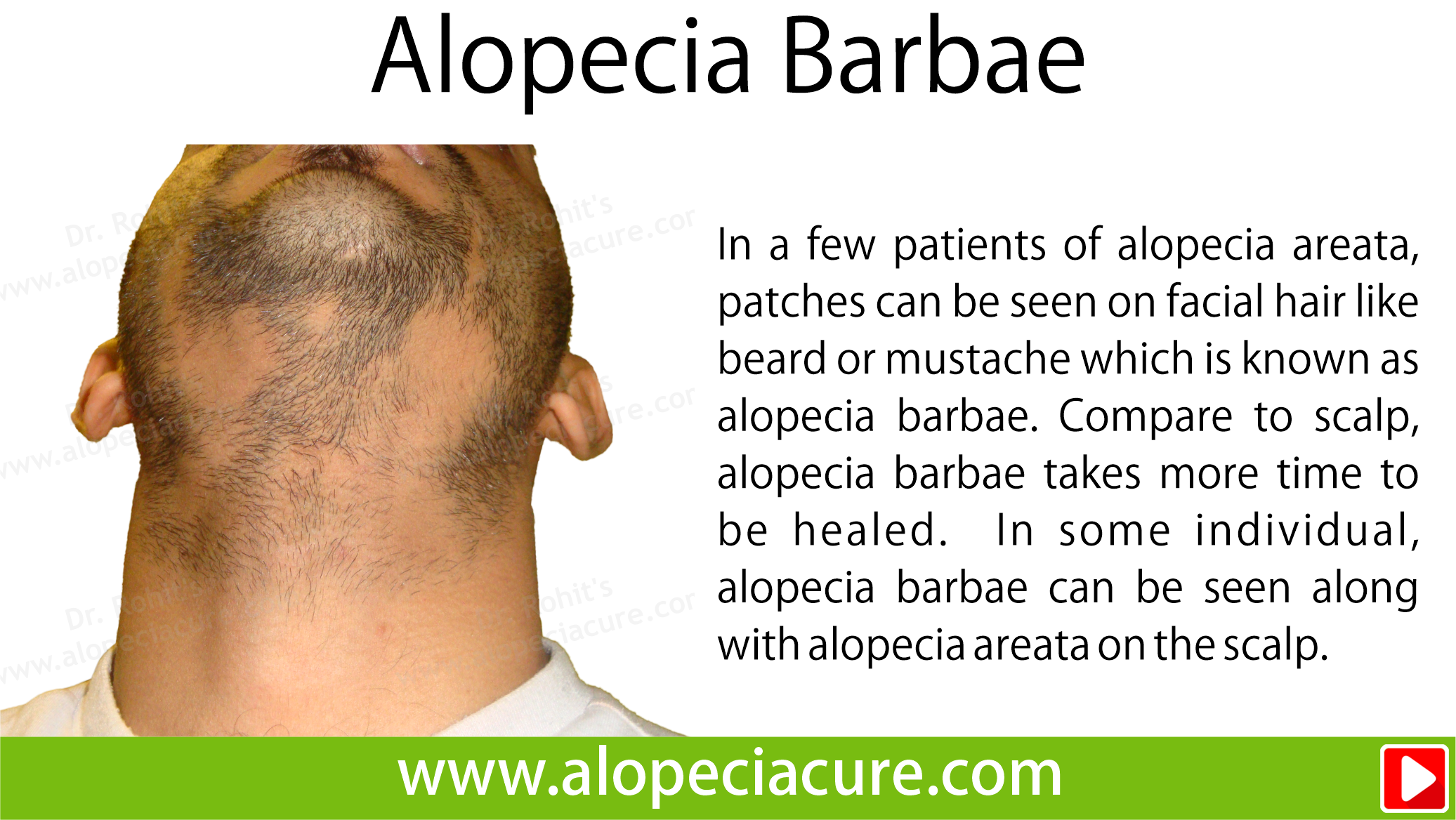alopecia barbae