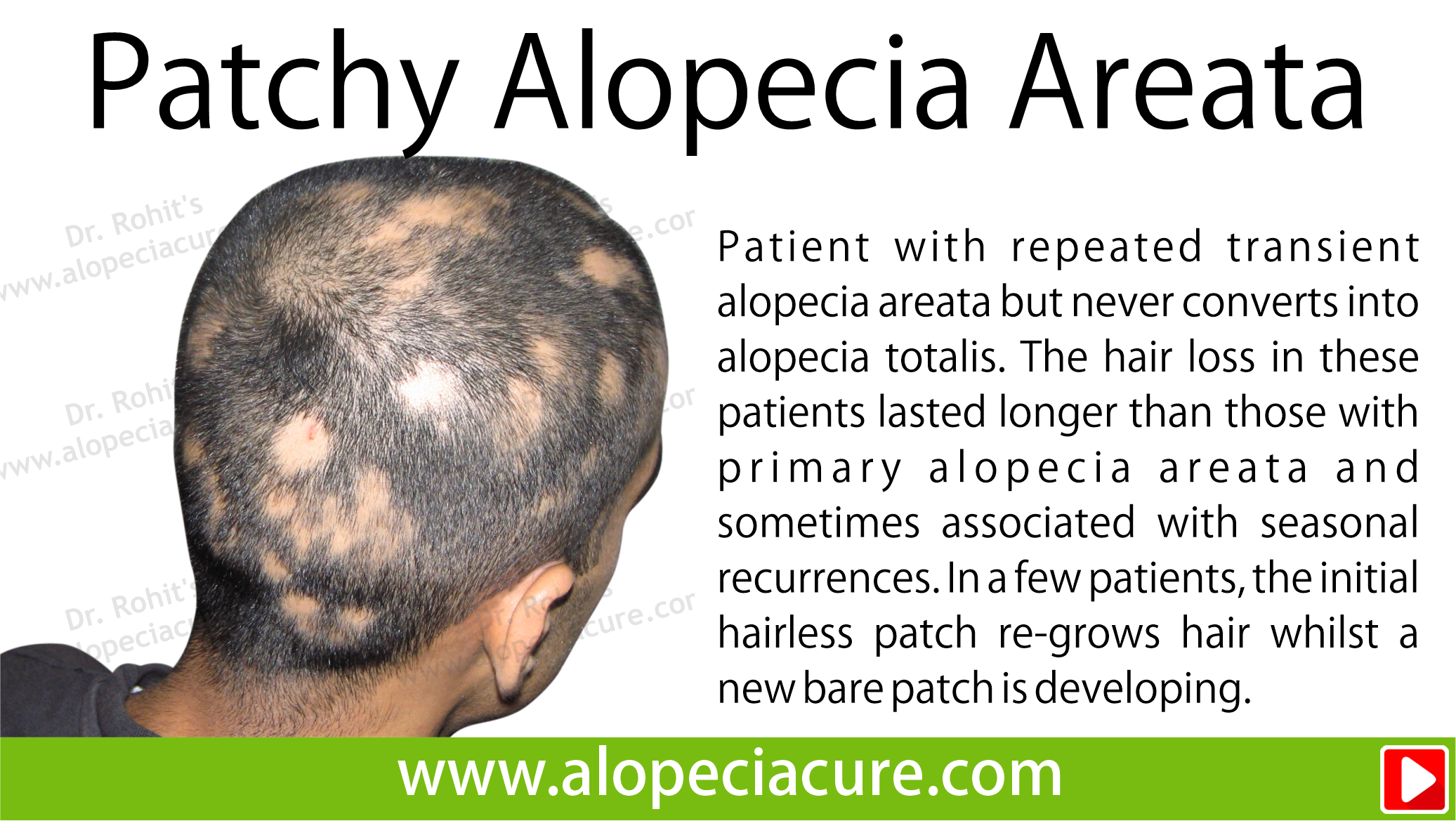 patchy alopecia areata