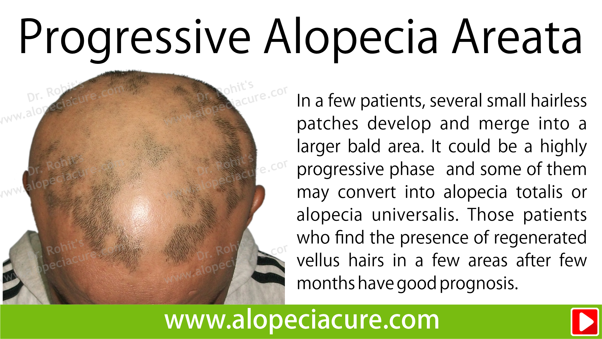 progressive alopecia areata