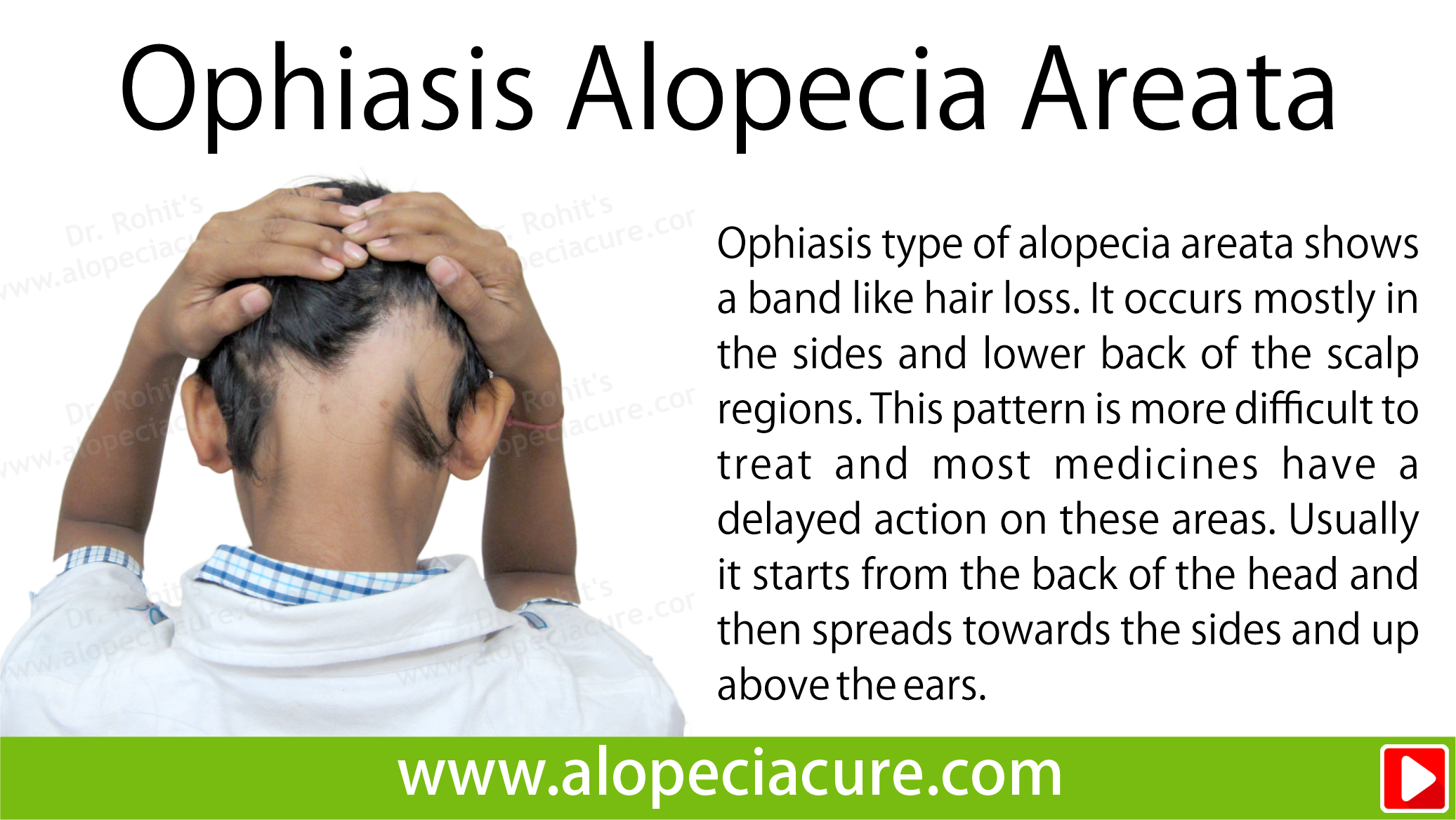 ophiyasis alopecia areata