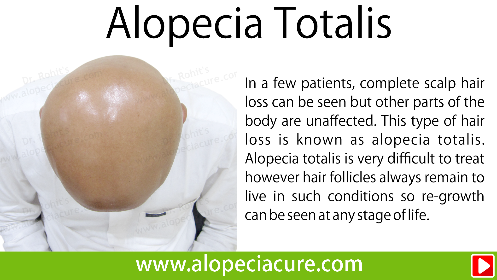 alopecia totalis