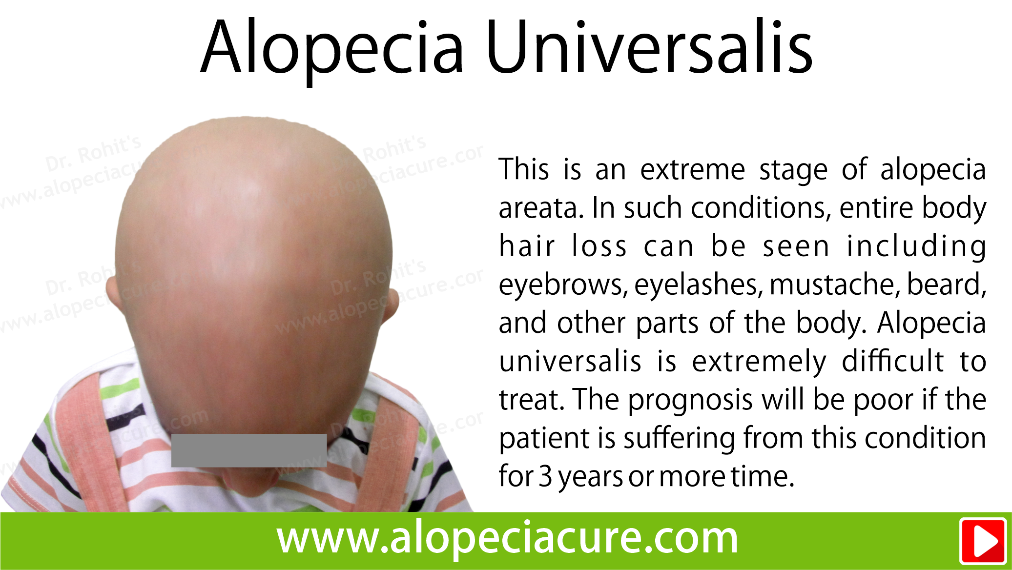 alopecia universalis