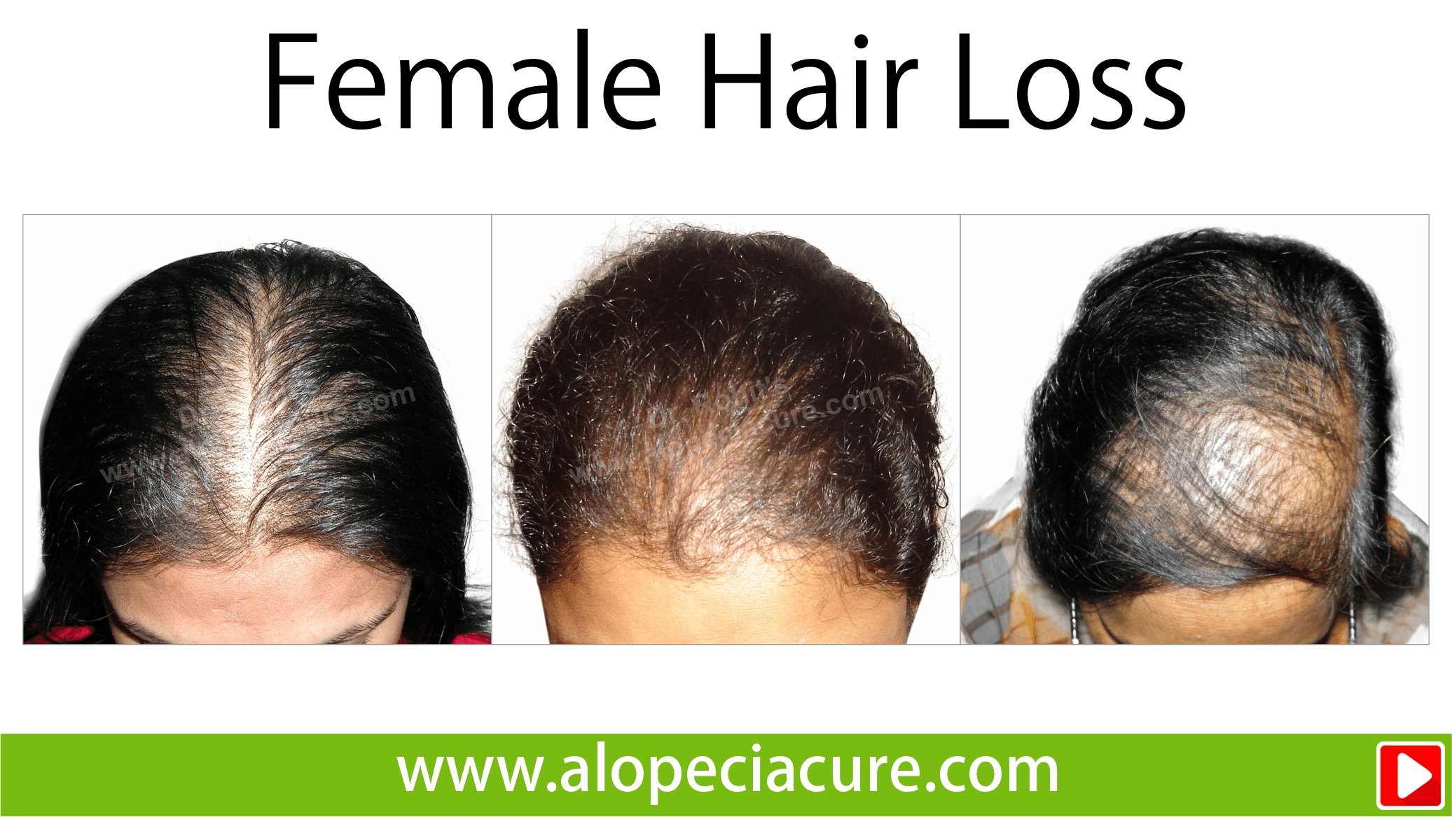 female hair loss treatment