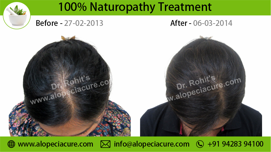 female hair loss treatment