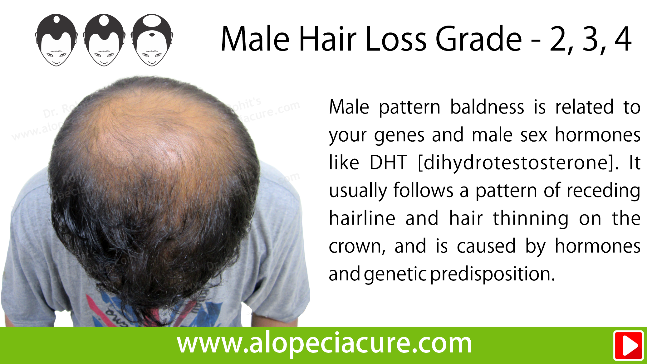 male hair loss treatment