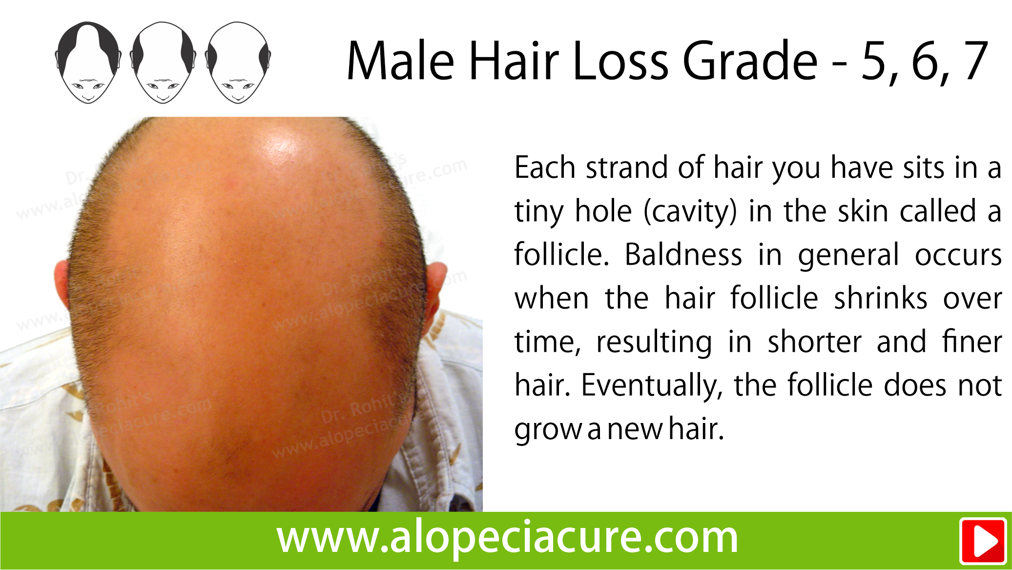 male hair loss treatment