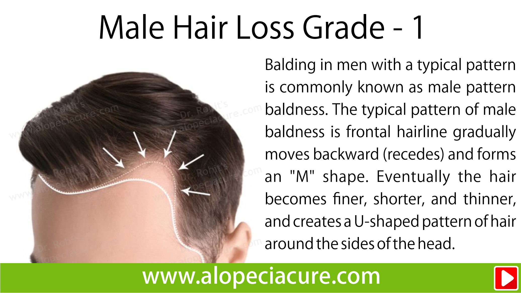 male hair loss treatment