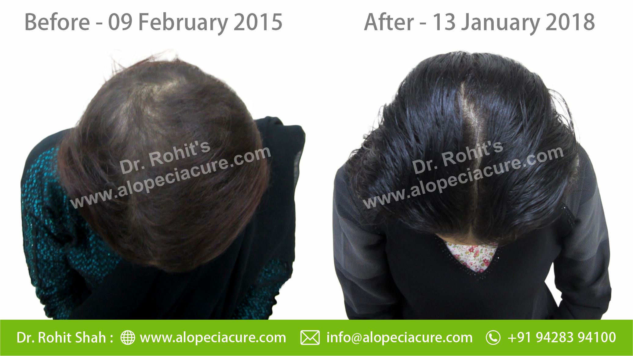 tractional alopecia treatment