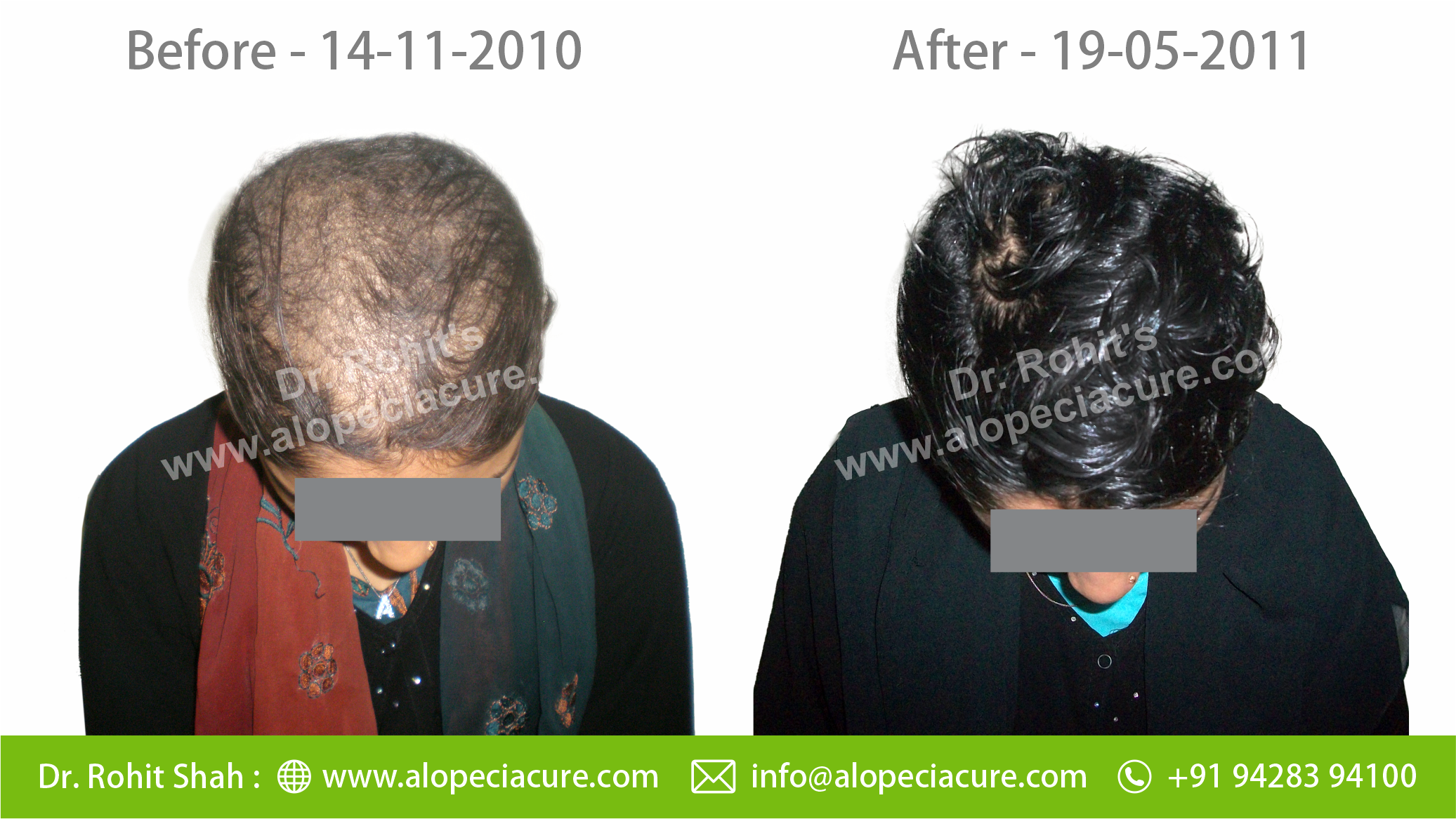 tractional alopecia treatment