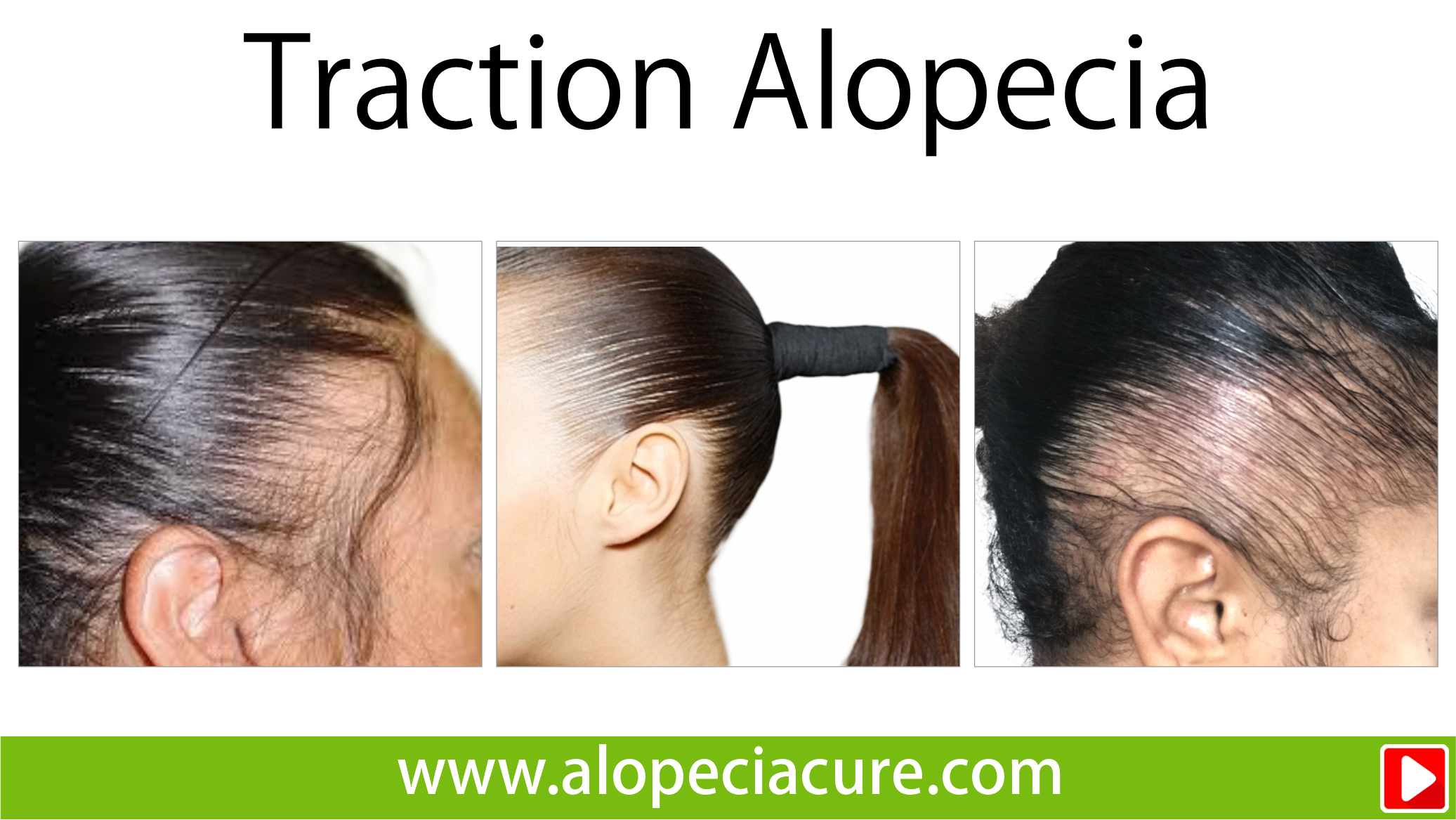 tractional alopecia treatment