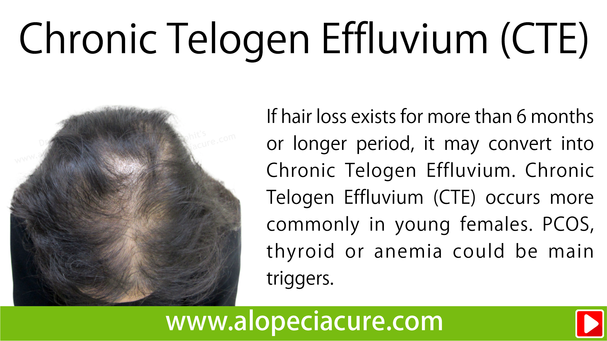 telogen effluvium